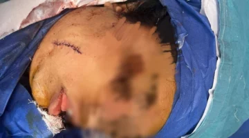 فريق طبي بجامعة القاهرة يتدخل لإنقاذ حياة فتاة ضحية حادث بالخصوص